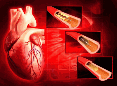 Here we cover this point in detail information Stent in heart, Stunt of heart, Stent placement, Stent surgery, Stent operation.