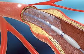 Here we cover this point in detail information
Stent in heart, Stunt of heart, Stent placement, Stent surgery, Stent operation.