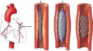 Here we cover this point in detail information
Stent in heart, Stunt of heart, Stent placement, Stent surgery, Stent operation.