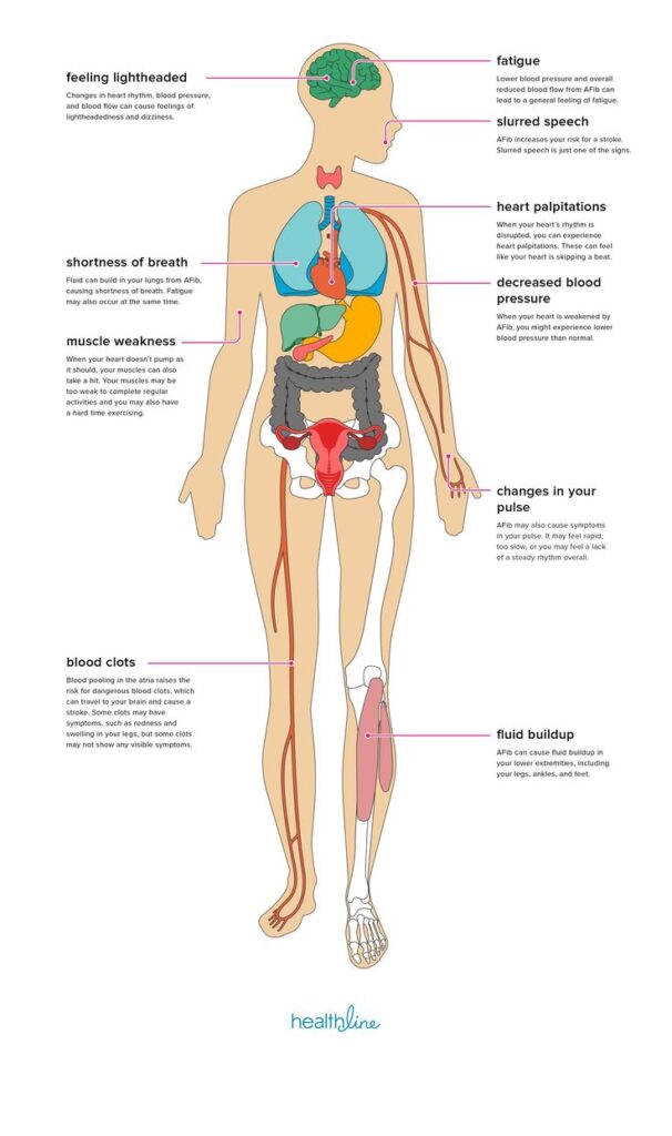 This blog mopre focus about Atrial fibrillation, Ablation for atrial fibrillation, Triggers atrial fibrillation, Irregular heartbeat, A fib treatment.