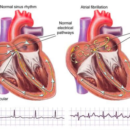 This blog mopre focus about Atrial fibrillation, Ablation for atrial fibrillation, Triggers atrial fibrillation, Irregular heartbeat, A fib treatment.